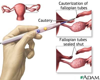 Surgical Sterilization