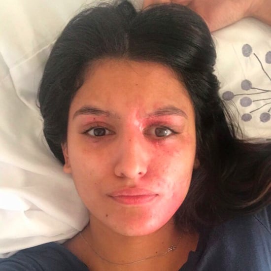 Resham Khan, Acid Burn Victim, Takes Makeup-Free Selfie