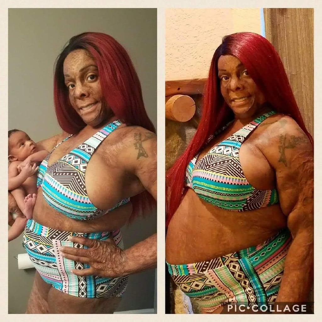 Burn Survivor Breastfeeding
