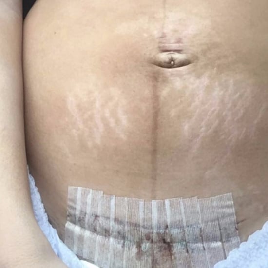 Mom Shares C-Section Postpartum Photo