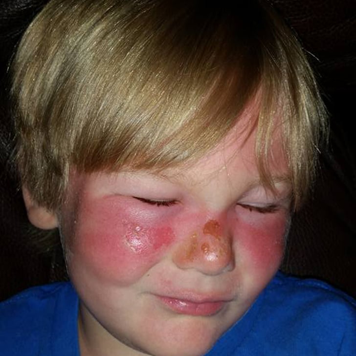 sunscreen burns face