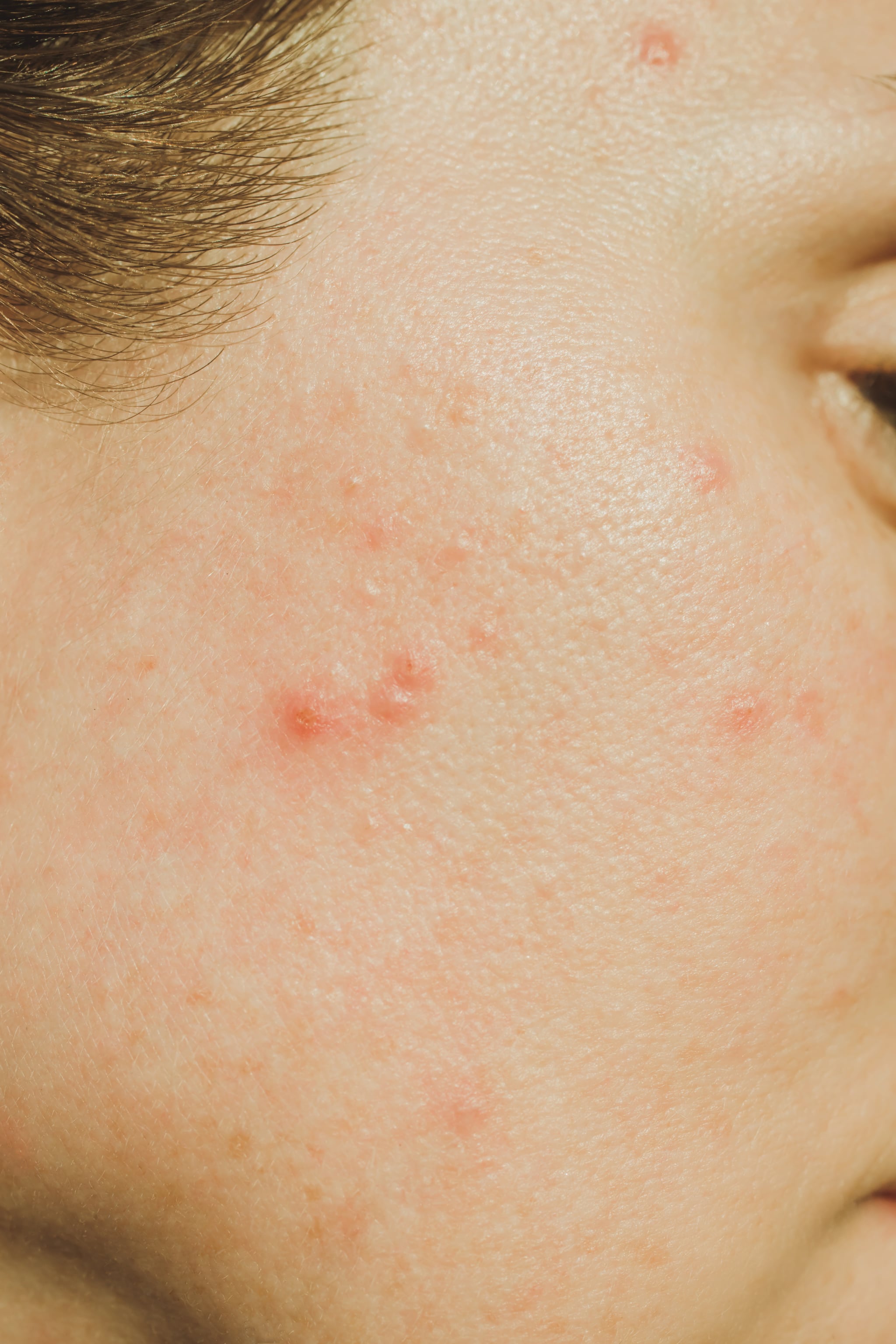 Adult acne closeup of skin with pimples and blemishes.