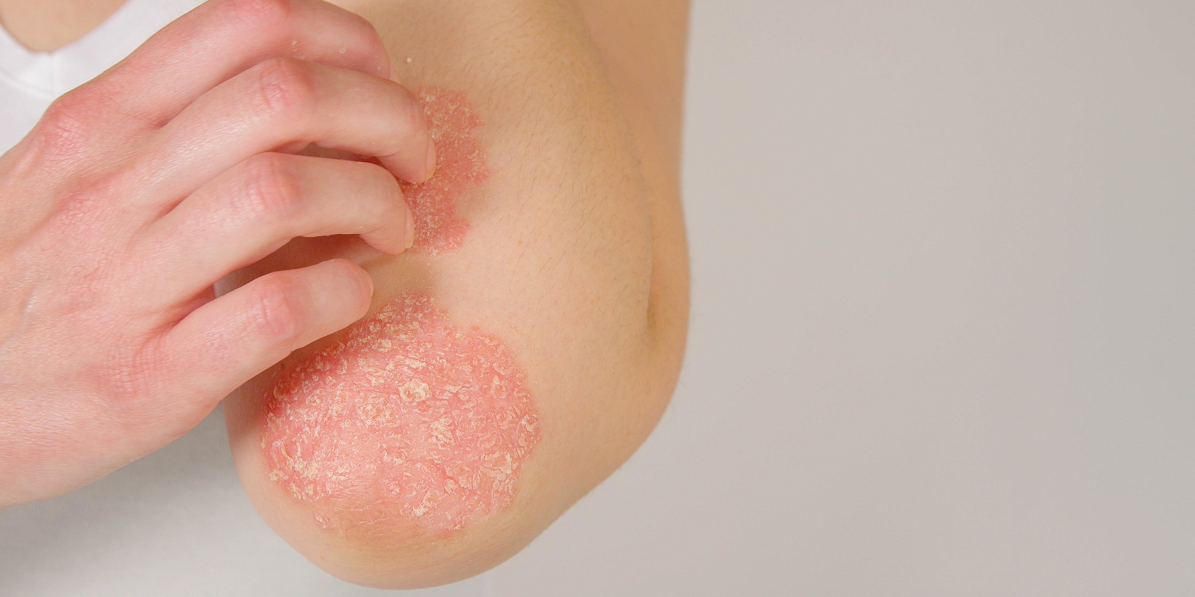 What Is Psoriasis? Dermatologists Break Down the Skin Condition
