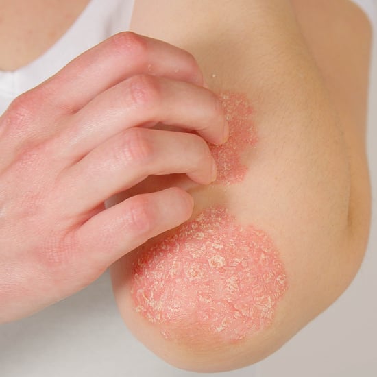 Psoriasis Symptoms and Treatments, From Dermatologists