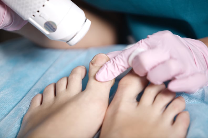 女人接受激光治疗她的脚治疗轻微的脚趾甲真菌感染的称为甲真菌病,或恢复皮肤夏天