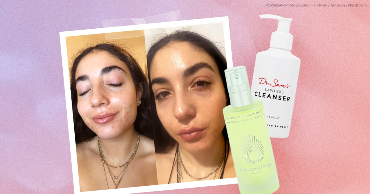 I’m on Accutane, and These Are the Products Saving My Dry Skin