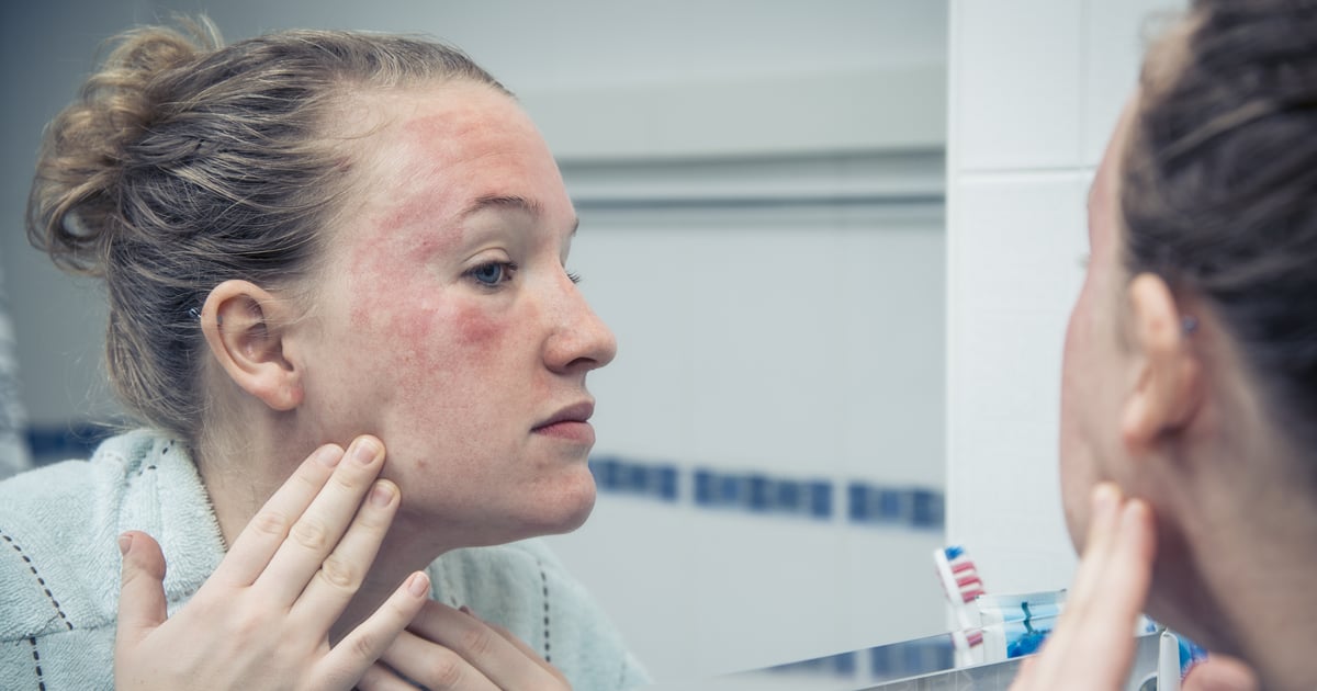 Facial Eczema How to Treat, Calm, and Prevent It POPSUGAR Beauty UK