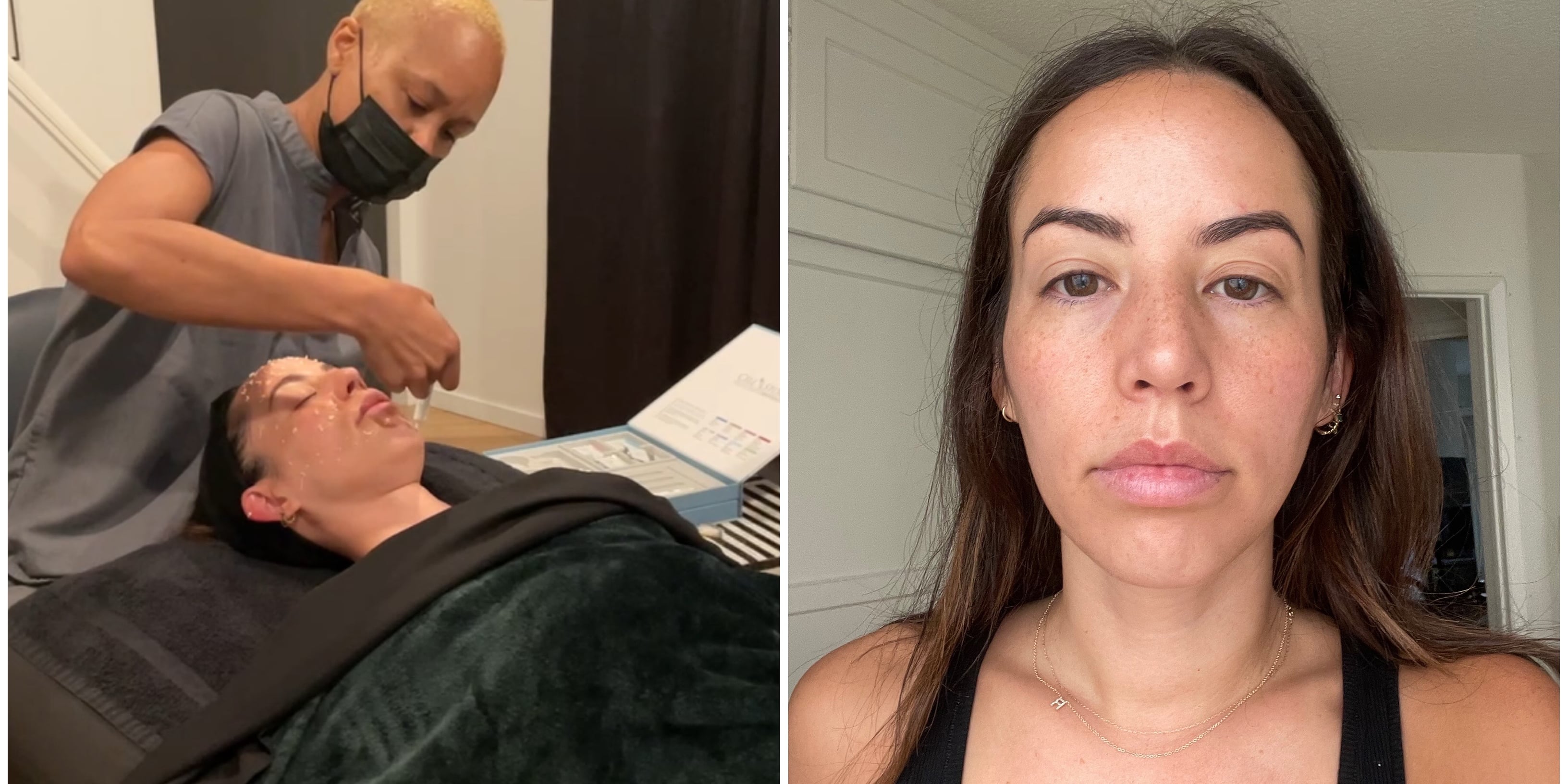 I Tried a Liquid Microneedling Treatment: See Photos - Vimarsana News