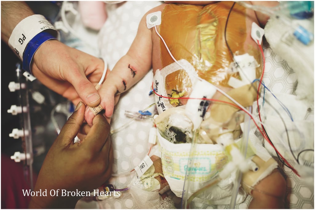 Twin With Heart Defect