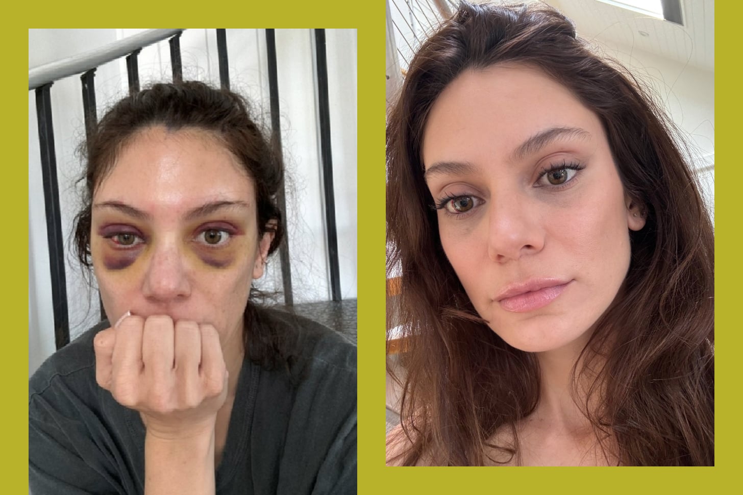 I Got An Endo Brow Lift: Before and After Photos | PS Beauty