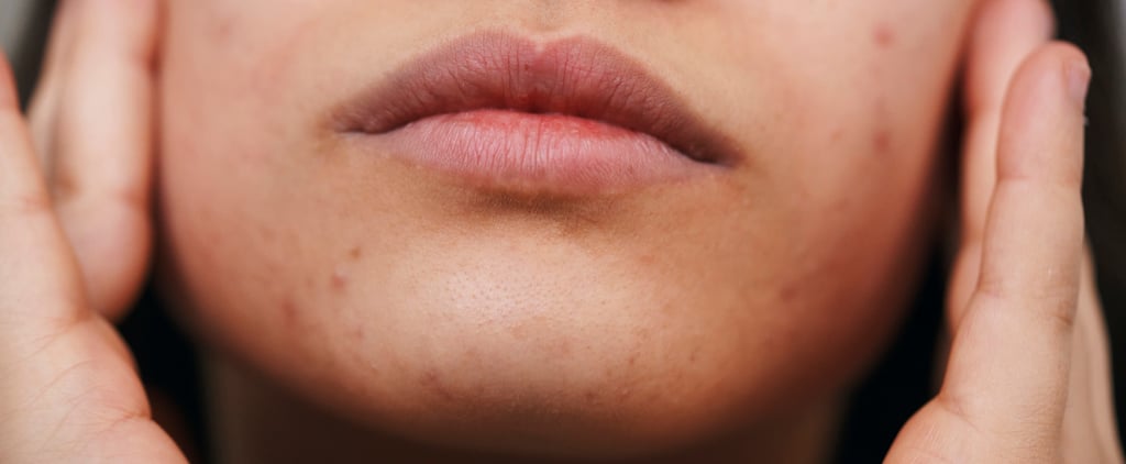 How to Get Rid of Acne Scars, According to Dermatologists
