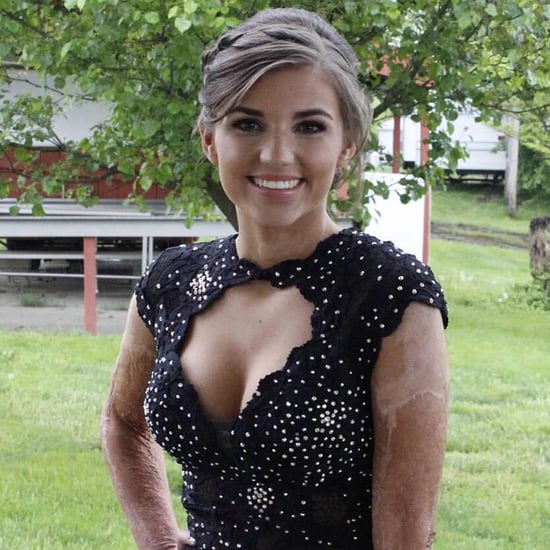Burn Survivor Kilee Brookbank Named Prom Queen (Video)