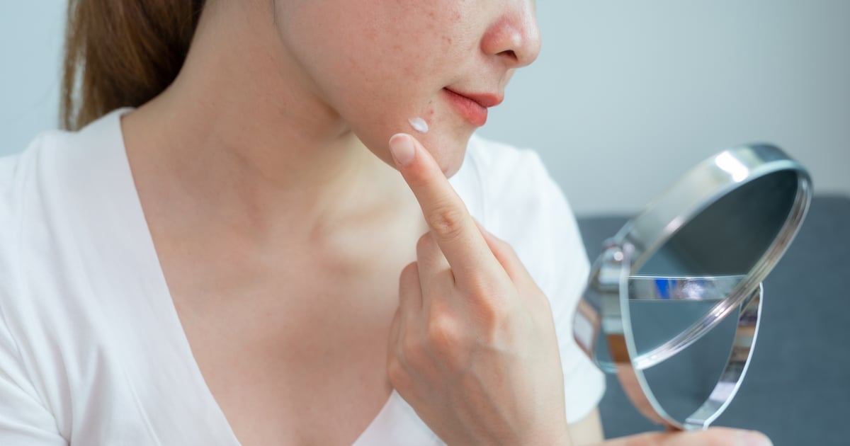 Hormonal Acne Causes and Treatments Times
