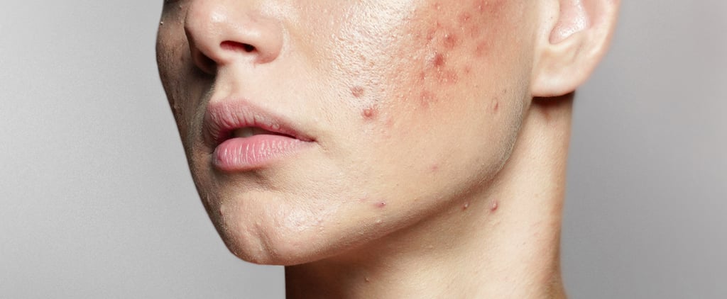 Experts Recommend the Best Acne Treatments For a Flare Up