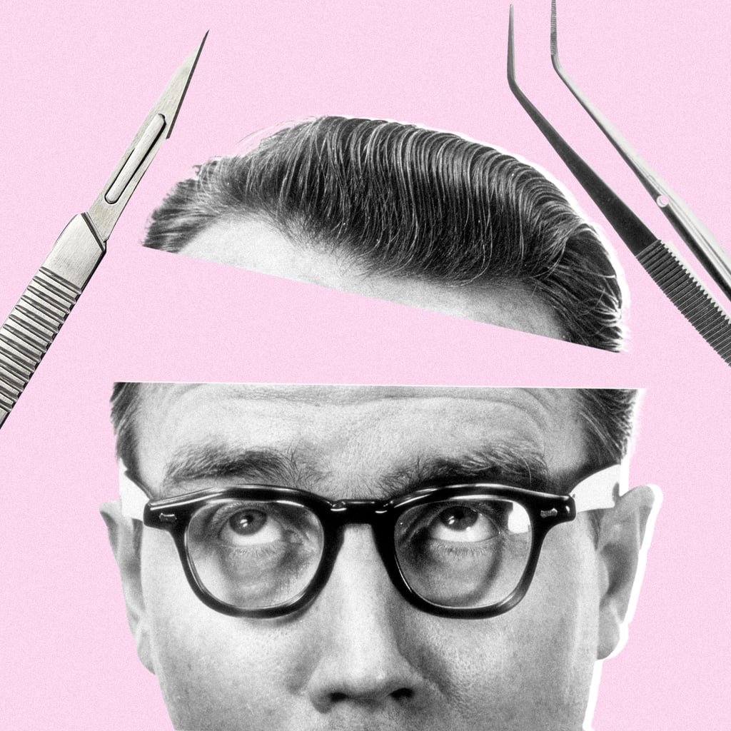 Hair Transplants: Types, How They Work, Cost, After Care