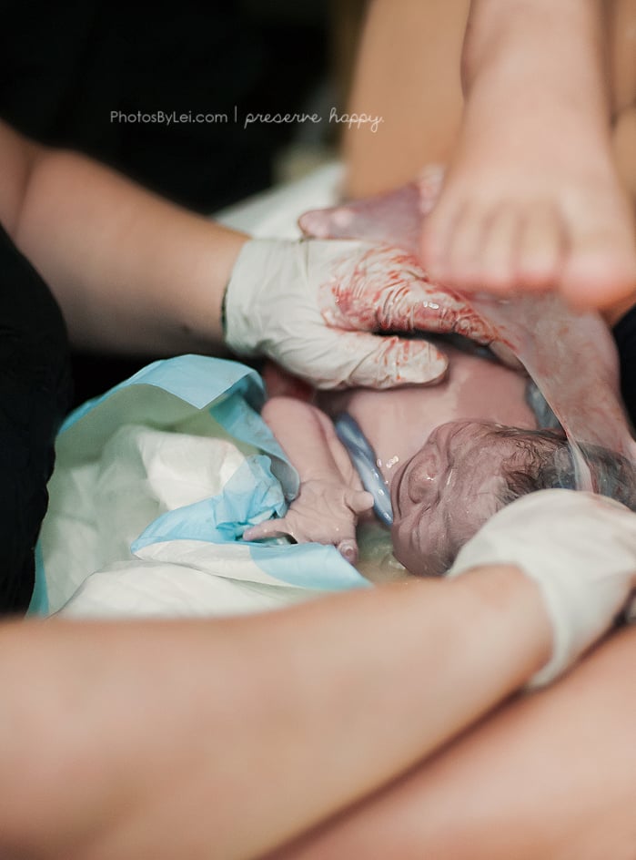 The midwives gently removing the infant from the sac.