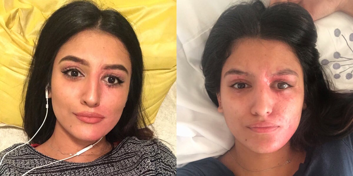 Resham Khan, Acid Burn Victim, Takes Makeup-Free Selfie ... - 1200 x 600 jpeg 99kB