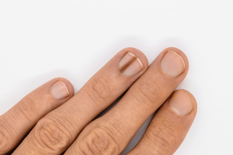 black line on nail, black lines on nails, splinter hemorrhages, line on fingernail, melanonychia, dark line on nail, normal black line on nail vs melanoma, black line on fingernail, brown line on nail, splinter hemorrhages nails, black lines under nails, 