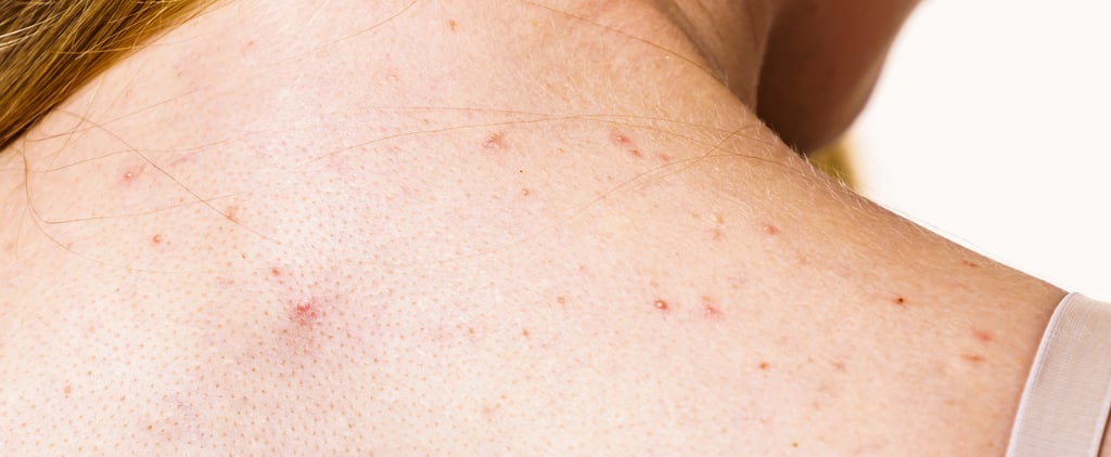 How to Get Rid of Back Acne: A Dermatologist Explains