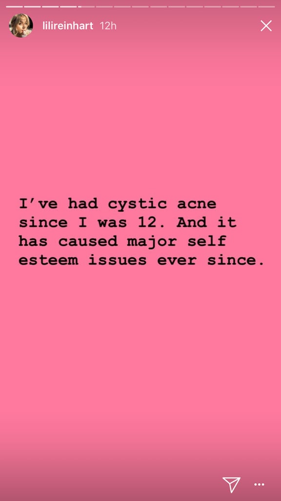 Lili Reinhart Posts About Cystic Acne on Instagram Stories