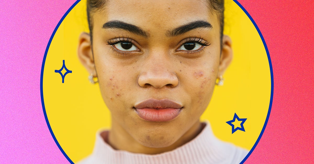 The Time Is Way Past Due to Normalize Having Acne