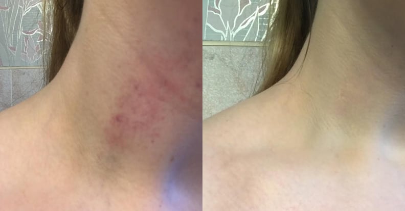 Hickies at work clearance