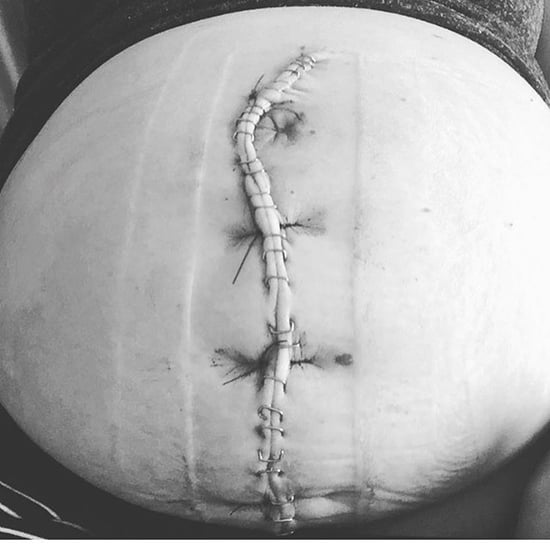 Why You Shouldn't Judge Moms Who Had C-Sections