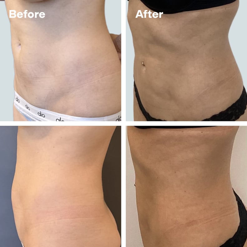 renuvion before and after and review