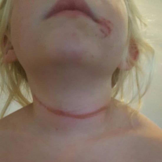 Child Nearly Hangs Herself on Slide With Hat String