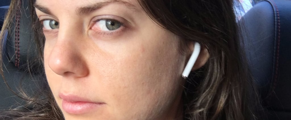 I Tried CO2 Fractional Laser: See Photos