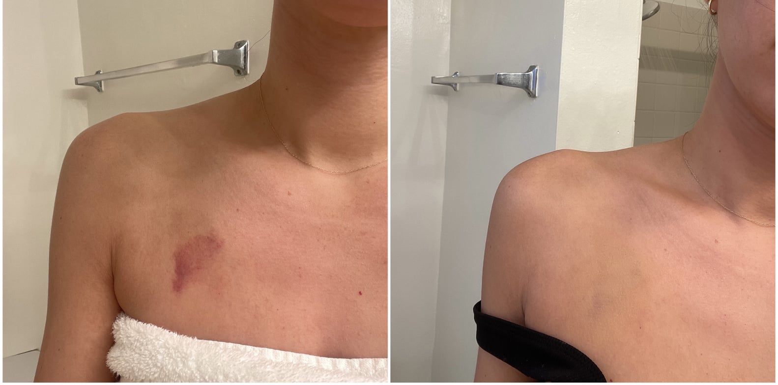 Best Concealers For Covering Hickeys See Photos POPSUGAR Beauty