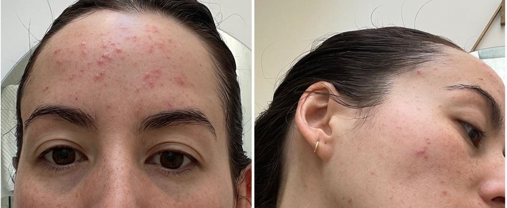 What Is Steroid Acne? Skin Tips From a Dermatologist