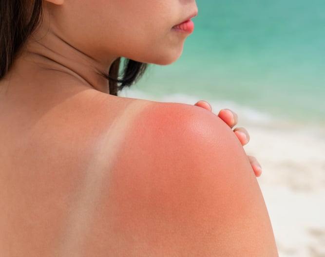 How to Heal a Sunburn ASAP, According to Skin-Care Experts