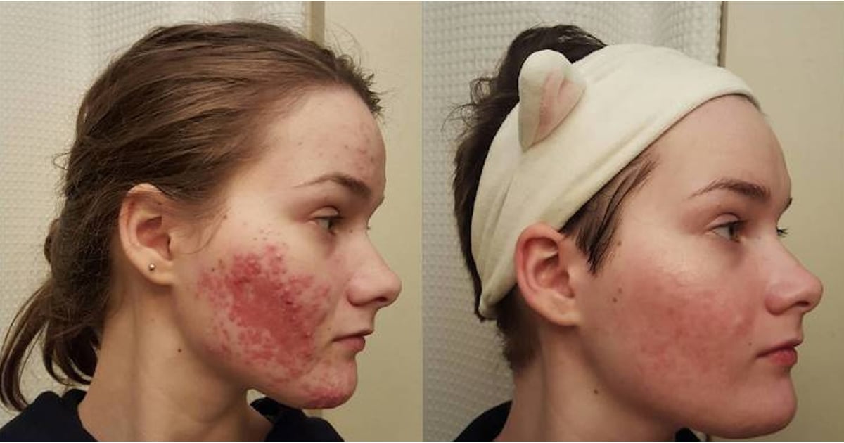 Microneedling in Charlotte, NC Charlotte Facial Resurfacing Treatment