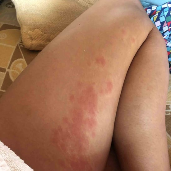 Chrissy Teigen Reveals Hives and Stretch Marks