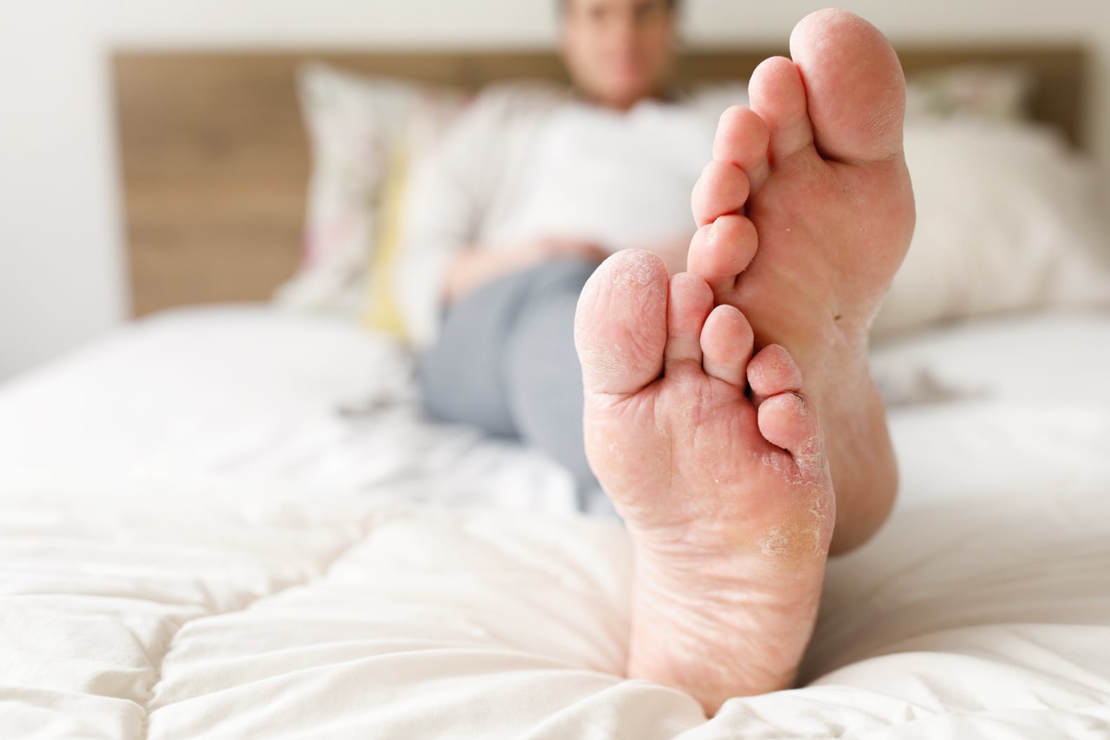 Why Are My Feet Peeling? POPSUGAR Fitness