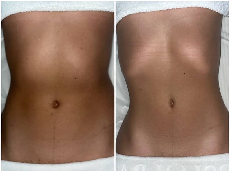 Brazilian lymphatic store drainage massage