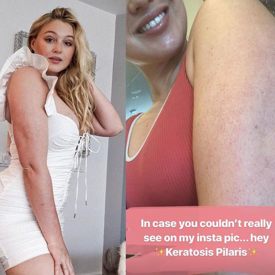 Iskra Lawrence Opens Up About Keratosis Pilaris on Instagram