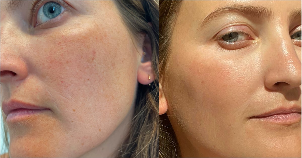 I Got a Laser Treatment to Treat the Broken Capillaries on My Face — Here's How It Went