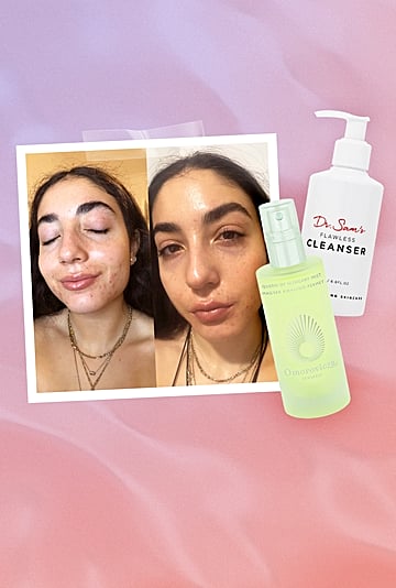 Keeping Acne Skin Hydrated on Accutane: An Expert Weighs In