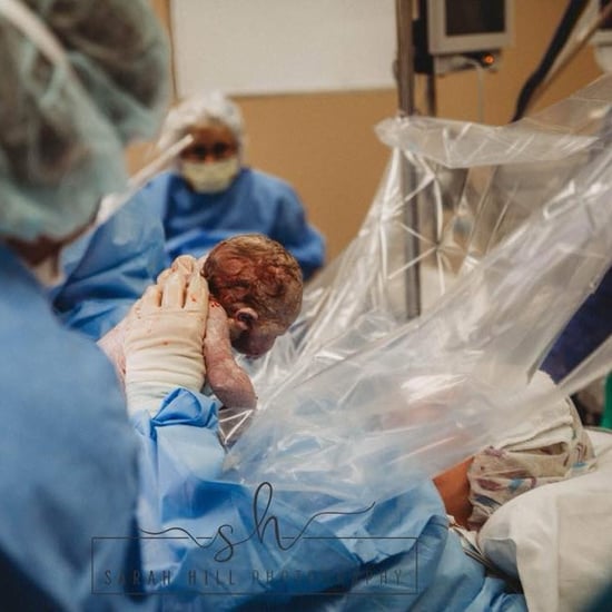 Midwife Delivers Own Baby Via C-Section