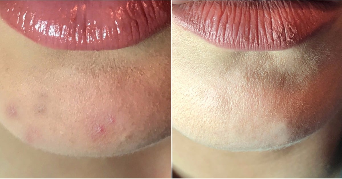 stuff for acne scars