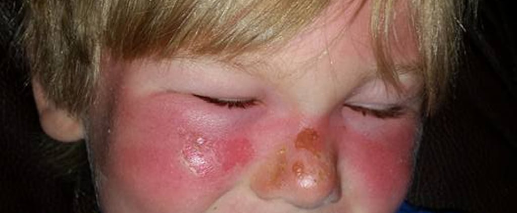 Boy Left With First-Degree Burns Despite Sunscreen