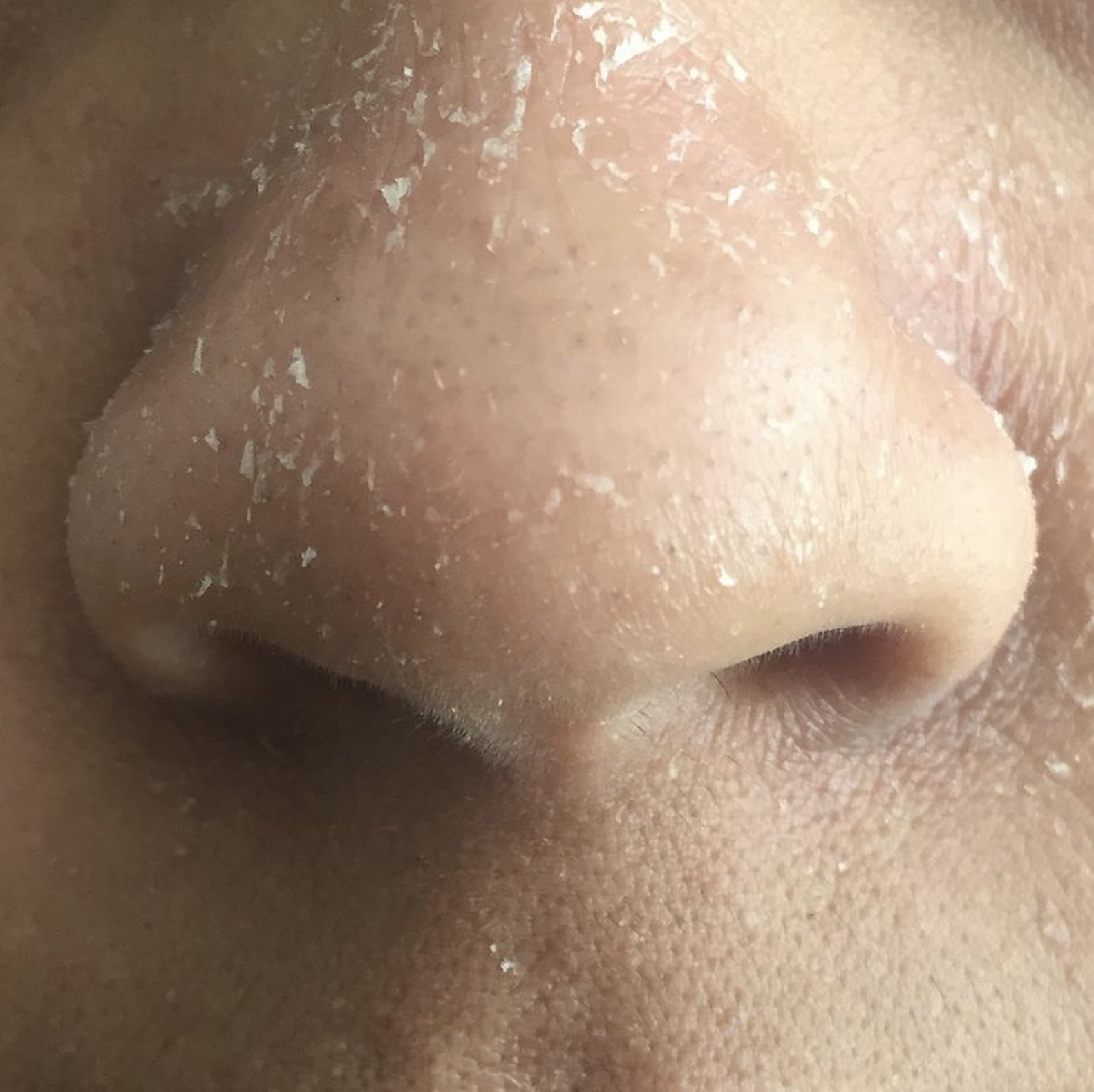 Facial Dandruff How to Treat It, According to a Skin Expert POPSUGAR