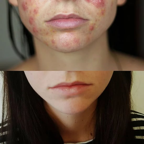 Can You Use Spironolactone to Treat Acne?