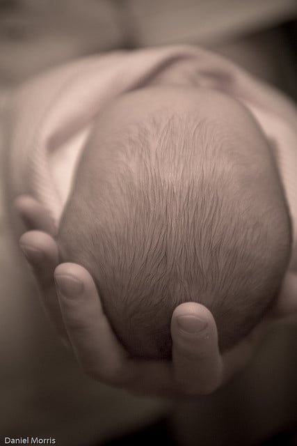 Cradle Cap