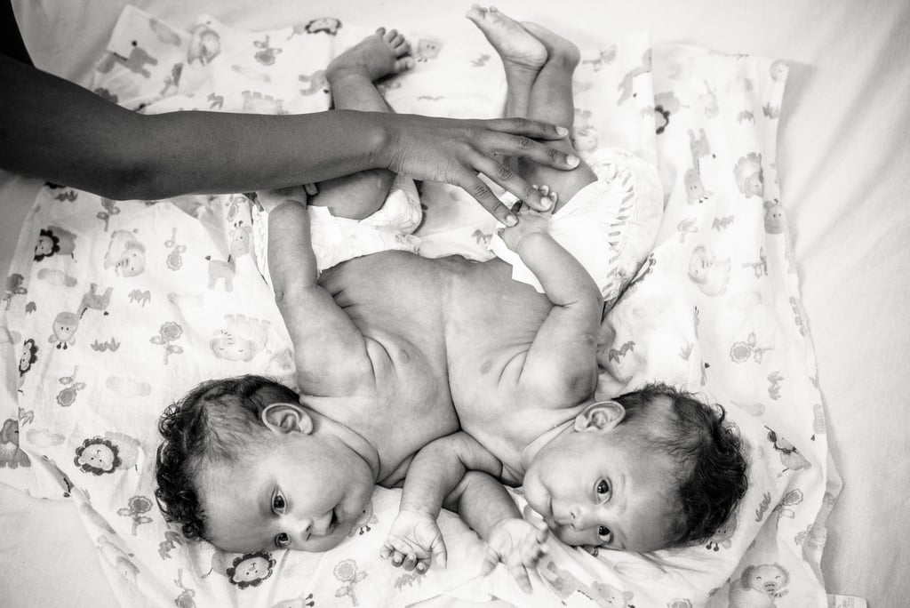 Photographer Captures the Beauty of Conjoined Twins