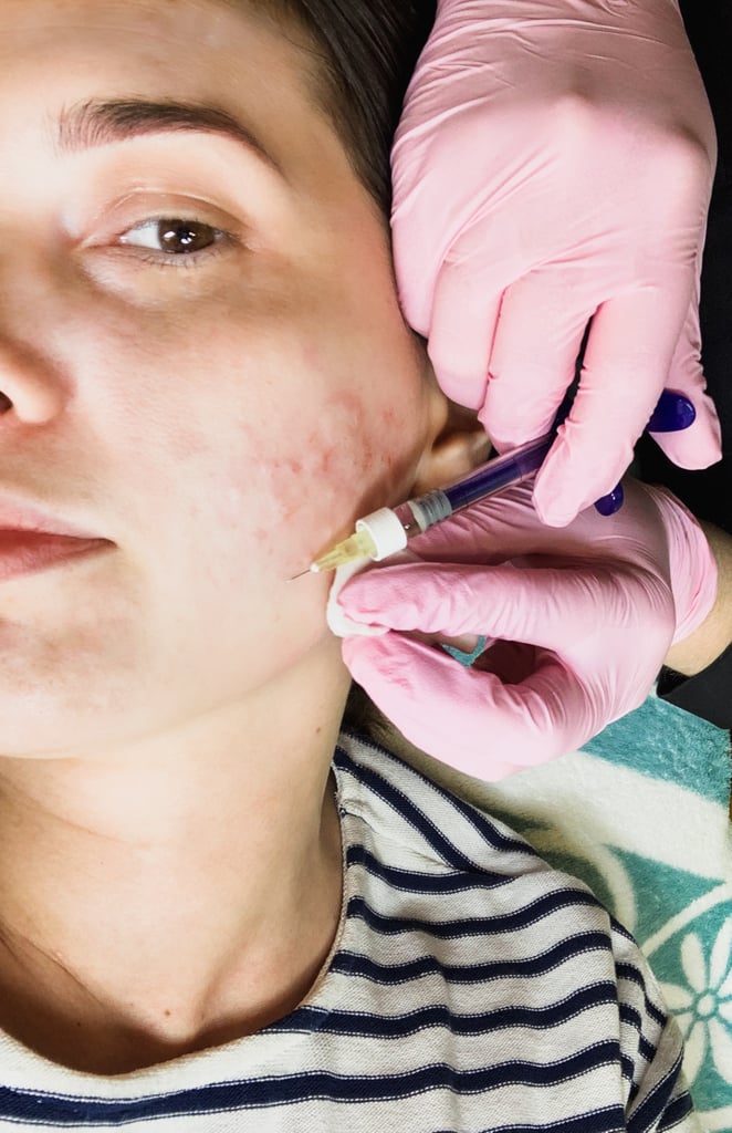 What Are the Risks or Side Effects to Cheek Filler?
The most common and totally normal side effects are swelling and light bruising. As with any cosmetic procedure there are also a few (very rare) risks to keep in mind. For fillers, vascular occlusion (where the filler goes into an artery) or blindness are the most serious. This is why you shouldn't skimp when it comes to choosing your doctor (more on that later). 
Dr. Samolitis also noted that sometimes vaccines or viral infections can cause fillers to react and get more swollen, but it's an unusual side effect and typically resolves on its own.
What Is the Downtime Like?
Prepare for a low-grade soreness right after getting your cheek fillers and into the next day. It's possible that there can be some swelling for a day or two and bruising, which could last a week, but it varies person to person. Dr. Samolitis advises using ice packs to reduce swelling and sleeping propped up for a day or two.
Is There Anything You Should Avoid After Getting Cheek Fillers?
Dr. Samolitis says that by the time you're walking out of your appointment, anything that's bleeding that would result in a bruise has already stopped. "You're not going to agitate anything or cause any new bleeding," she said. However, you should avoid strenuous exercise for at least 24 hours or however long it takes for you to feel like you're not swollen. Drinking alcohol or taking ibuprofen after your appointment is fine (in moderation, of course), and you should wait around two weeks before getting a facial massage or having anything tight like goggles around your face.
How to Choose the Right Doctor
Real talk: injectables can essentially be administered by anyone with any type of medical license, and only take completing a weekend course to start seeing patients. So when it comes to injecting something into your face, skip the Groupon or med spa.
It's important to do your research and see a board-certified dermatologist or a nurse practitioner who works alongside a board-certified derm. Choose someone who is practiced in the art of injectables and has the creds to back it up — this is not the time to cut corners. Dr. Samolitis also stressed how crucial it is to not be afraid to ask questions, and that your doctor takes the time to answer every single one. Trust is key.