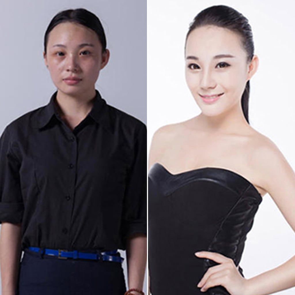 Cosmetic Surgery Before and After Photos From Korea POPSUGAR Beauty Australia