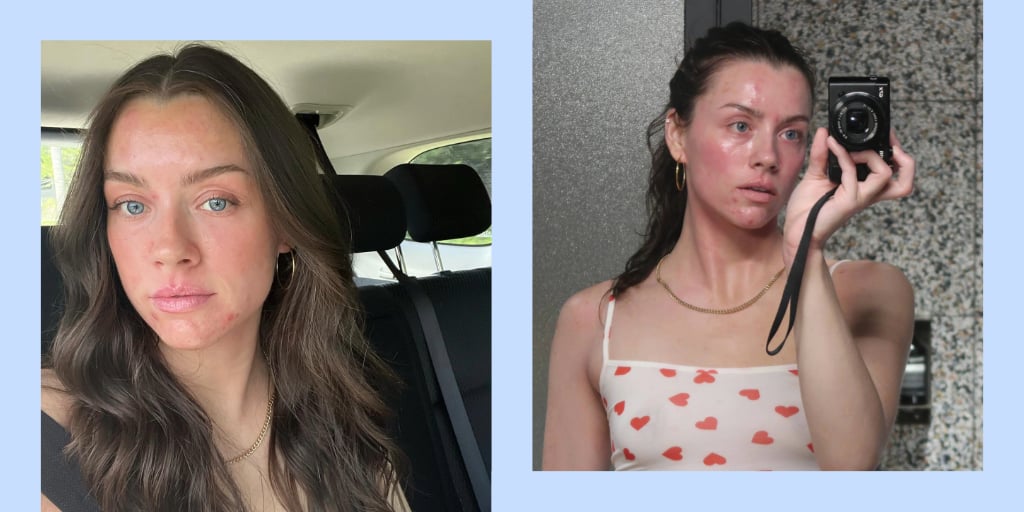 Skinfluencer Madeleine Edwards Doesn't Let Eczema Flare-Ups Run Her Life